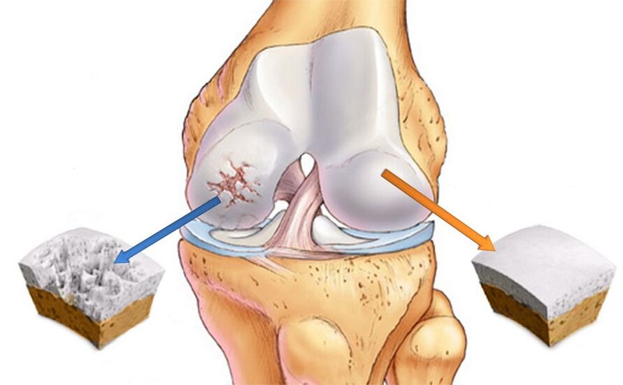 Arthritis and Healthy Cartilage of the Knee