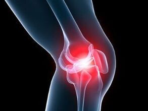 Knee pain caused by osteoarthritis of the knee