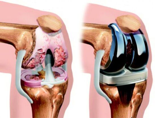 Outcomes of Knee Replacement Surgery for Arthropathy