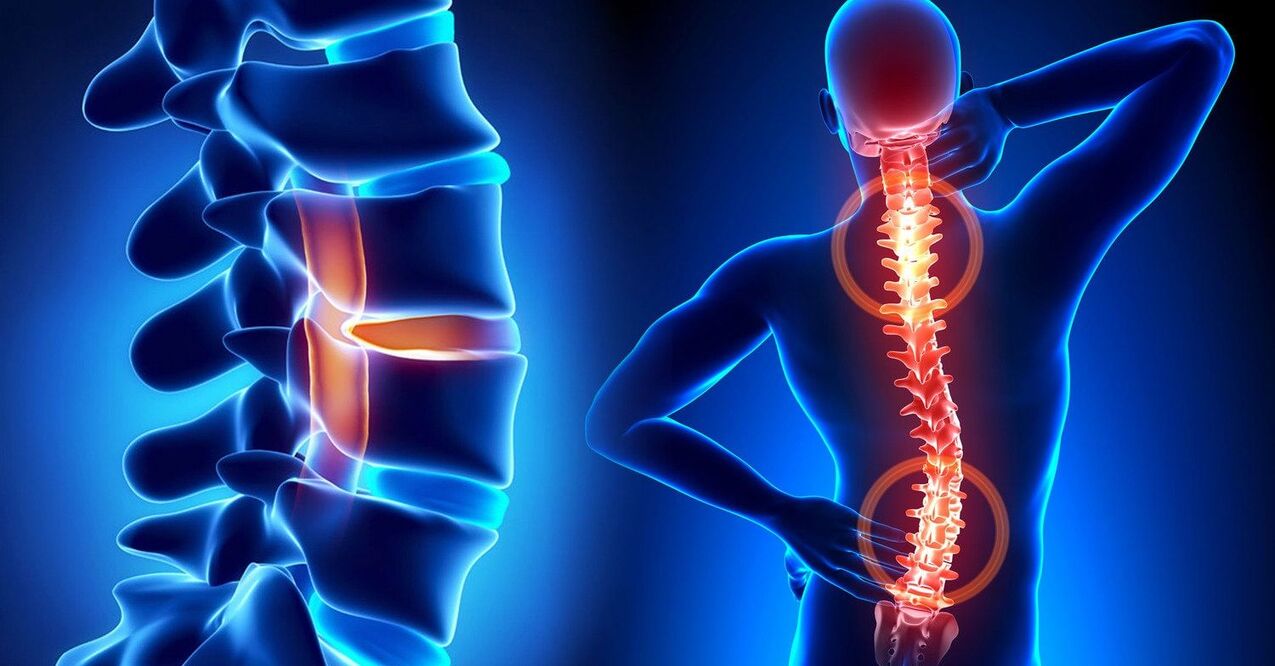 Spine disease can lead to neck problems