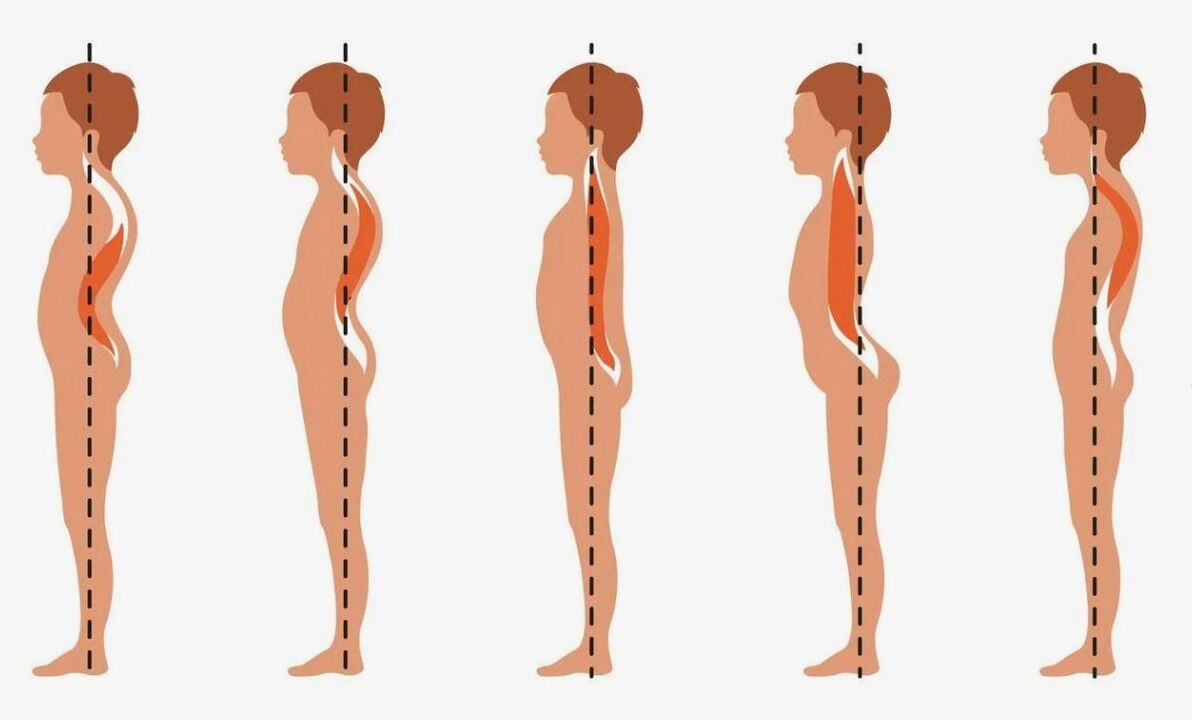 The progression of lumbar osteochondrosis