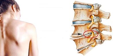 The development mechanism of cervical osteochondral disease