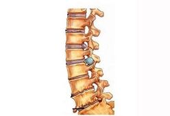 The development stage of cervical osteochondrosis