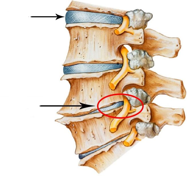 Development of intervertebral disc hernia