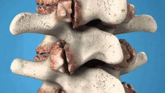Bone plants of vertebrae - pathological growth, damage to nerves and blood vessels