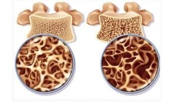 Dangers of cervical suction in women