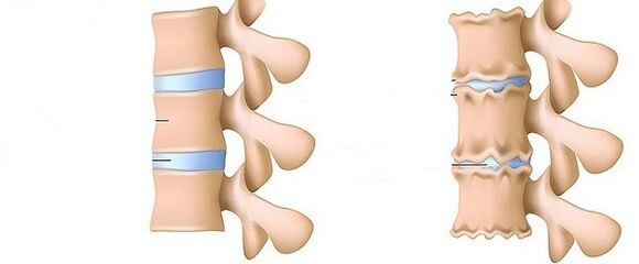 Healthy spinal and osteochondral diseases