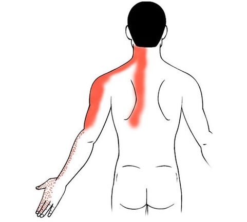 Cervical Osteochondrosis Causes Finger Joint Pain