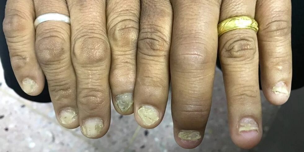 Finger swelling and nail plate deformation may indicate the development of psoriatic arthritis