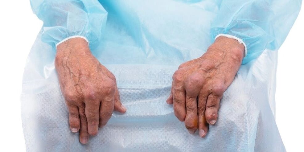 Infectious arthritis is a condition that causes persistent pain and changes in the finger joints.