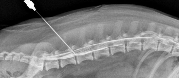 Obstructing the spine with osteochondrosis