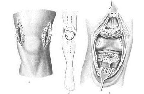 Arthrotomy for Arthropathy