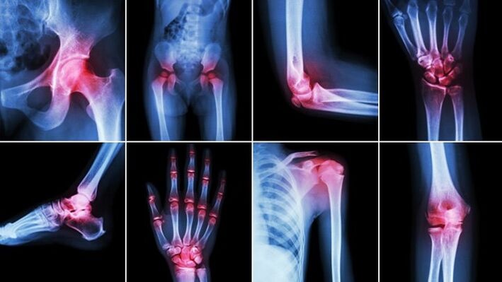 Body joints affected by arthropathy